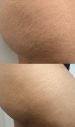 Stretch mark before and after healing. Stretch mark before and after healing.
